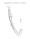 METHODS FOR REMOVING KIDNEY STONES FROM THE URETER diagram and image