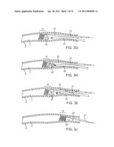 METHODS FOR REMOVING KIDNEY STONES FROM THE URETER diagram and image