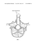 Vertebral Body Nerve and Vein Cauterizing System and Method diagram and image