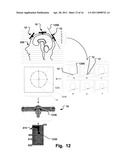 Stereotactic Therapy System diagram and image