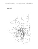 INTERSPINOUS PROCESS IMPLANT AND METHOD OF IMPLANTATION diagram and image