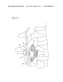 INTERSPINOUS PROCESS IMPLANT AND METHOD OF IMPLANTATION diagram and image