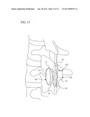 INTERSPINOUS PROCESS IMPLANT AND METHOD OF IMPLANTATION diagram and image