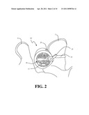 Methods and Apparatus For Treating Spinal Stenosis diagram and image