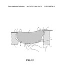 Methods and Apparatus For Treating Spinal Stenosis diagram and image