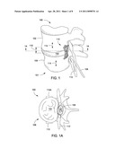 APPARATUS FOR COMPRESSING OR DECOMPRESSING A SPINAL DISC AND METHOD OF USE THEREOF diagram and image