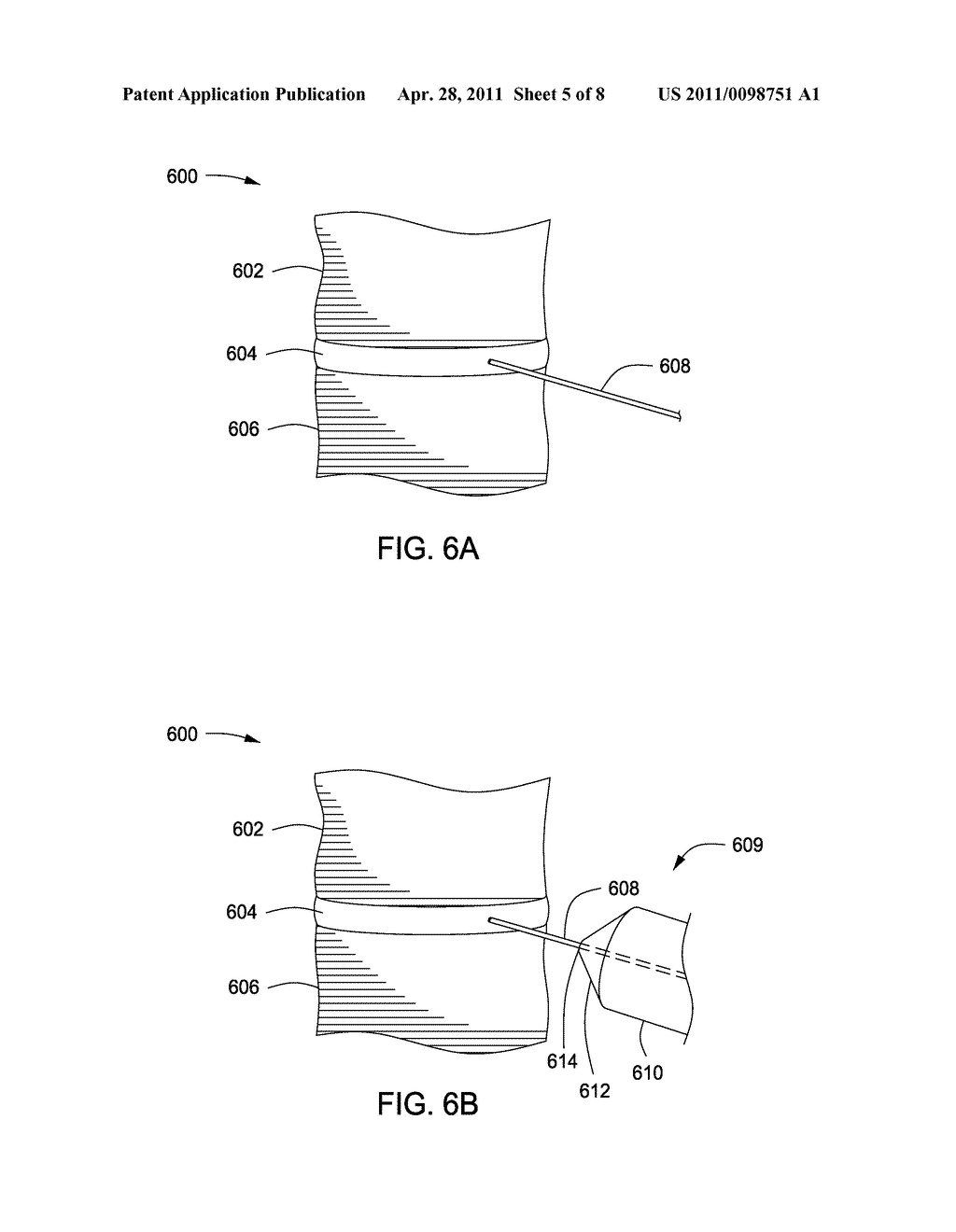 APPARATUS FOR COMPRESSING OR DECOMPRESSING A SPINAL DISC AND METHOD OF USE THEREOF - diagram, schematic, and image 06