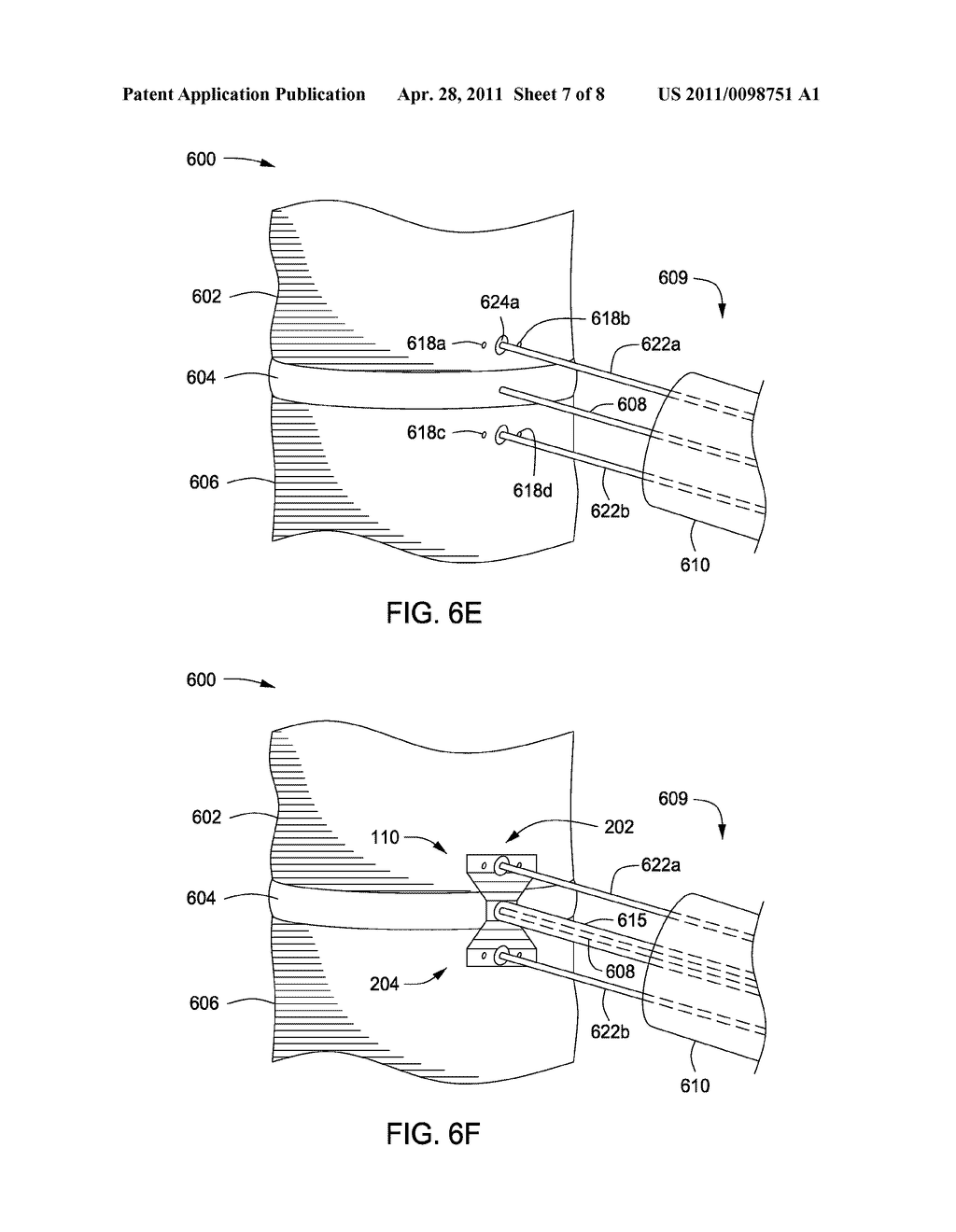 APPARATUS FOR COMPRESSING OR DECOMPRESSING A SPINAL DISC AND METHOD OF USE THEREOF - diagram, schematic, and image 08