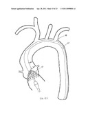 STENTED TRANSCATHETER PROSTHETIC HEART VALVE DELIVERY SYSTEM AND METHOD diagram and image