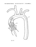 STENTED TRANSCATHETER PROSTHETIC HEART VALVE DELIVERY SYSTEM AND METHOD diagram and image