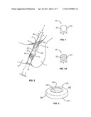 SACRO-ILIAC JOINT IMPLANT SYSTEM AND METHOD diagram and image