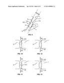 SACRO-ILIAC JOINT IMPLANT SYSTEM AND METHOD diagram and image