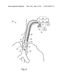 METHOD OF DETECTING ENDOTRACHEAL TUBE MISPLACEMENT diagram and image
