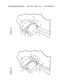 FLUID FILLED IMPLANTS FOR TREATING OBSTRUCTIVE SLEEP APNEA diagram and image