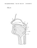 FLUID FILLED IMPLANTS FOR TREATING OBSTRUCTIVE SLEEP APNEA diagram and image