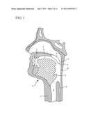 FLEXIBLE IMPLANTS HAVING INTERNAL VOLUME SHIFTING CAPABILITIES FOR TREATING OBSTRUCTIVE SLEEP APNEA diagram and image