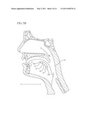 FLEXIBLE IMPLANTS HAVING INTERNAL VOLUME SHIFTING CAPABILITIES FOR TREATING OBSTRUCTIVE SLEEP APNEA diagram and image