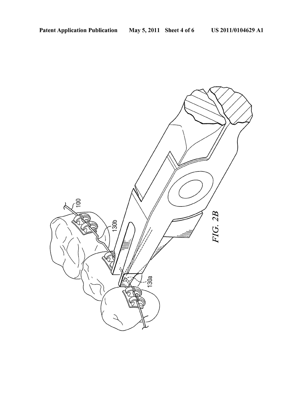Apparatus and Method for Adjusting Orthodontic Wire - diagram, schematic, and image 05