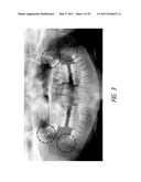 THERAPEUTIC TOOTH ABLATION diagram and image