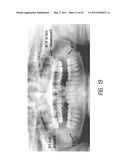 THERAPEUTIC TOOTH ABLATION diagram and image