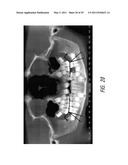 THERAPEUTIC TOOTH ABLATION diagram and image