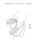 THERAPEUTIC TOOTH ABLATION diagram and image