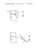 RESHAPABLE DEVICE FOR FIXATION AT A DENTAL SITE diagram and image