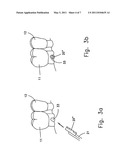 RESHAPABLE DEVICE FOR FIXATION AT A DENTAL SITE diagram and image