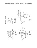 RESHAPABLE DEVICE FOR FIXATION AT A DENTAL SITE diagram and image