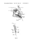 VARIABLY MOUNTABLE IMPLANT WITH STEPPED SOCKET diagram and image