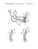 VARIABLY MOUNTABLE IMPLANT WITH STEPPED SOCKET diagram and image