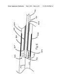 Ultrasound-enhanced Stenosis therapy diagram and image