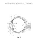 SYSTEM AND METHOD FOR TREATING AN OCULAR DISORDER diagram and image