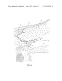 SYSTEM AND METHOD FOR TREATING AN OCULAR DISORDER diagram and image