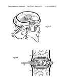 Treating back pain by re-establishing the exchange of nutrient & waste diagram and image