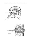 Treating back pain by re-establishing the exchange of nutrient & waste diagram and image