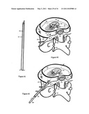 Treating back pain by re-establishing the exchange of nutrient & waste diagram and image