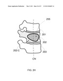 ANTERIOR INFLATION BALLOON diagram and image