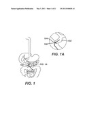 Catheter For Deactivating At Least A Portion of the Digestive Enzymes In An Amount Of Bile diagram and image