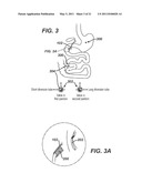 Catheter For Deactivating At Least A Portion of the Digestive Enzymes In An Amount Of Bile diagram and image