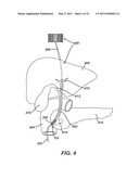 Catheter For Deactivating At Least A Portion of the Digestive Enzymes In An Amount Of Bile diagram and image