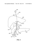 Catheter For Deactivating At Least A Portion of the Digestive Enzymes In An Amount Of Bile diagram and image