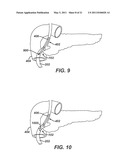 Catheter For Deactivating At Least A Portion of the Digestive Enzymes In An Amount Of Bile diagram and image