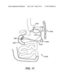 Catheter For Deactivating At Least A Portion of the Digestive Enzymes In An Amount Of Bile diagram and image