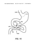 Catheter For Deactivating At Least A Portion of the Digestive Enzymes In An Amount Of Bile diagram and image