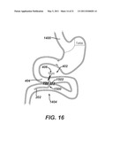 Catheter For Deactivating At Least A Portion of the Digestive Enzymes In An Amount Of Bile diagram and image