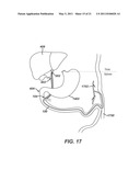 Catheter For Deactivating At Least A Portion of the Digestive Enzymes In An Amount Of Bile diagram and image