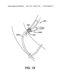 Catheter For Deactivating At Least A Portion of the Digestive Enzymes In An Amount Of Bile diagram and image