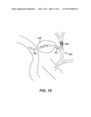 Catheter For Deactivating At Least A Portion of the Digestive Enzymes In An Amount Of Bile diagram and image