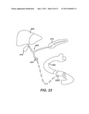 Catheter For Deactivating At Least A Portion of the Digestive Enzymes In An Amount Of Bile diagram and image